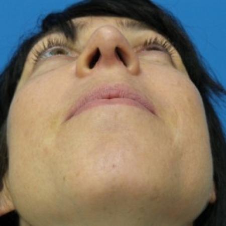 After image 4 Case #86856 - 40 year old woman treated with Nose Surgery/Septoplasty/Turbinectomy