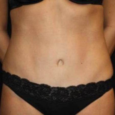 After image 1 Case #83391 - Abdominoplasty - 39 year old female.