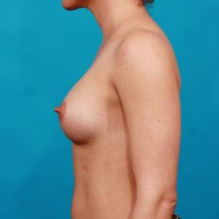 After image 3 Case #85761 - Shaped Breast Augmentation