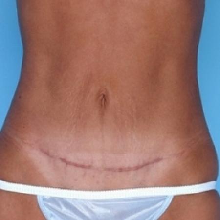 After image 1 Case #79166 - Tummy Tuck