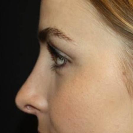 After image 3 Case #85266 - Rhinoplasty - 20 year old female
