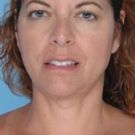 After image 1 Case #79231 - Liposuction