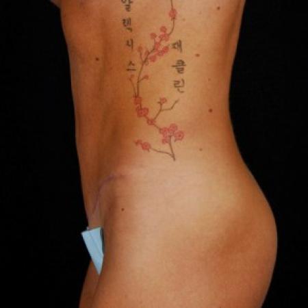 After image 3 Case #81571 - Tummy Tuck
