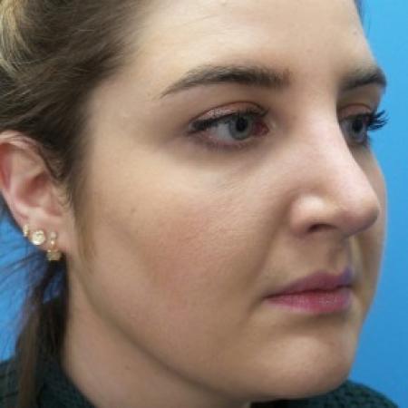 After image 2 Case #86551 - Rhinoplasty  3 months post-op