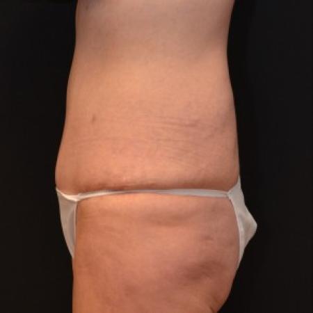 After image 3 Case #81721 - Tummy Tuck