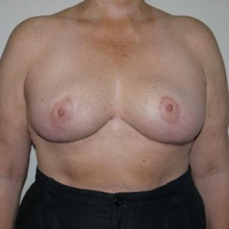 After image 1 Case #82326 - 60 year old breast reduction