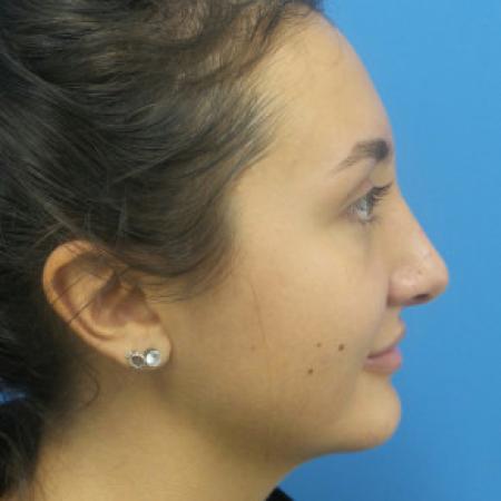 After image 3 Case #88381 - 21 year-old  -  Rhinoplasty  -  4 months post-op