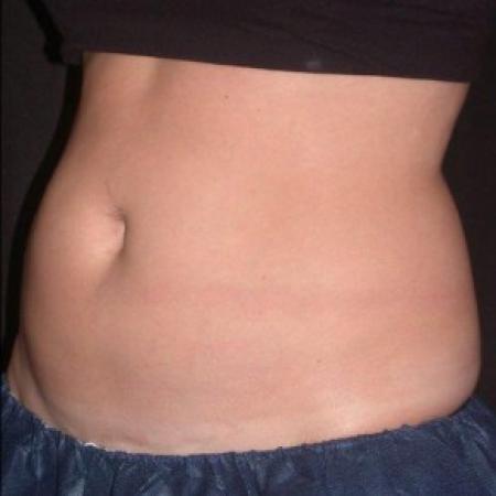 After image 1 Case #81856 - CoolSculpting