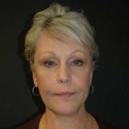 After image 1 Case #80871 - Facelift, Fat Transfer, Lower Blepharoplasty