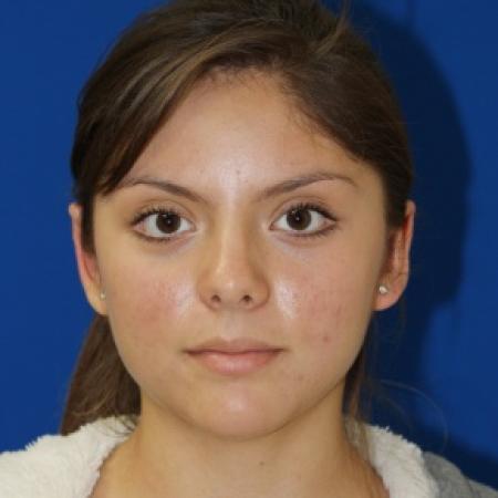 After image 1 Case #79941 - Otoplasty Ear surgery