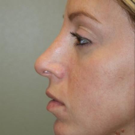 After image 2 Case #81891 - Open Structure Septorhinoplasty