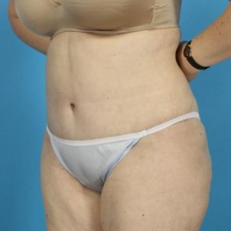 After image 2 Case #84076 - Abdominoplasty with Flank Lipo