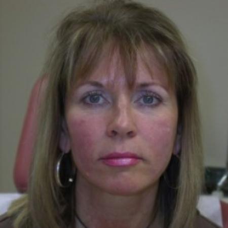 After image 1 Case #81146 - Cheek injections using Radiesse