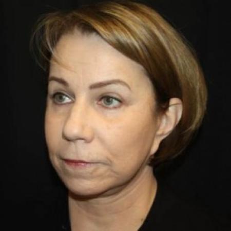 After image 2 Case #85231 - Facelift/Facial Rejuvenation - 64 year old female