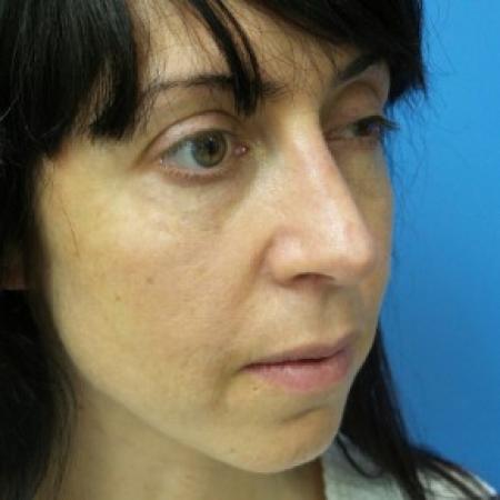 After image 2 Case #86856 - 40 year old woman treated with Nose Surgery/Septoplasty/Turbinectomy