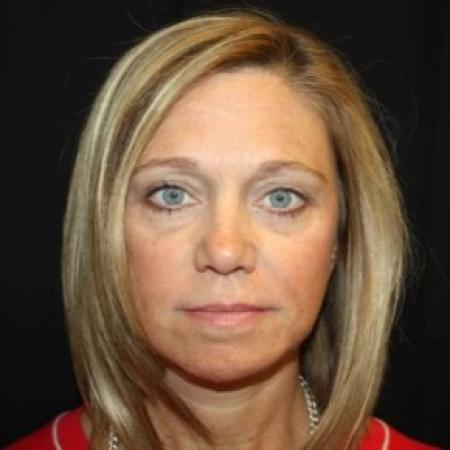 After image 1 Case #83761 - Facelift - 49 year old female.