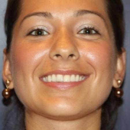 After image 2 Case #80786 - OTOPLASTY