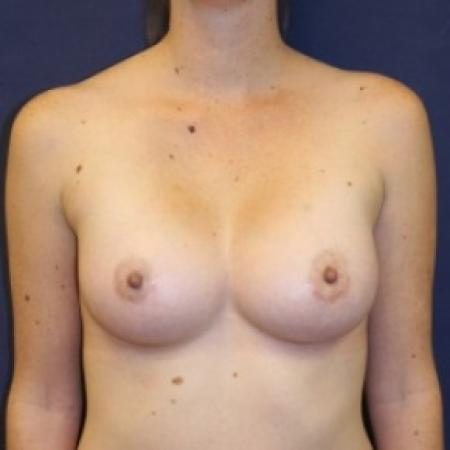 After image 1 Case #81216 - Breast Augmentation