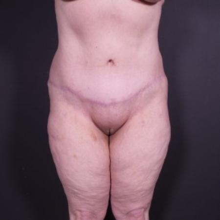After image 1 Case #85256 - Abdominoplasty after Bariatric Surgery