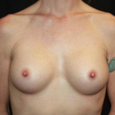 After image 1 Case #86056 - Breast Augmentation - 40 year old female