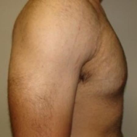 After image 5 Case #79046 - Gynecomastia