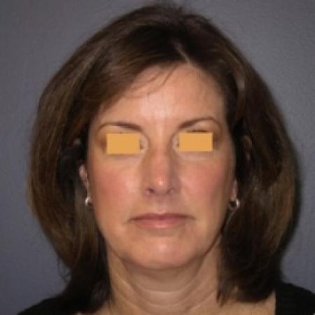 After image 1 Case #81151 - Rhinoplasty