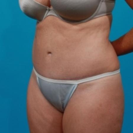 After image 2 Case #78856 - Abdominoplasty & Flank Liposuction