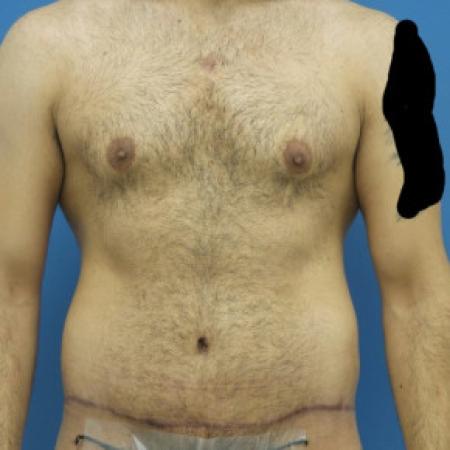 After image 1 Case #88446 - 34 year old  -  Gynecomastia Reduction/Circumferential Body Lift -  3 months post-op 