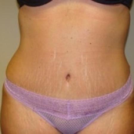 After image 1 Case #79471 - Tummy Tuck