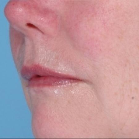 After image 3 Case #79286 - Injectables