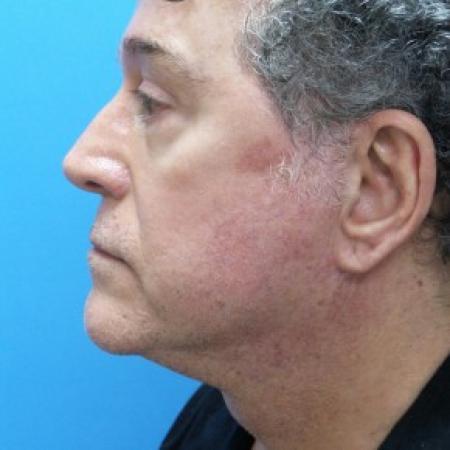 After image 3 Case #86716 - Facelift/Upper Blepharoplasty/Browlift - 1 year post-op