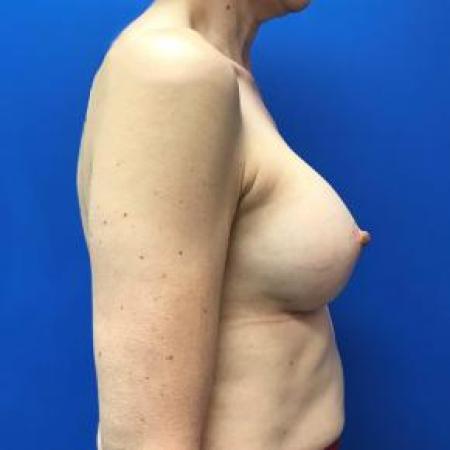 After image 2 Case #88186 - Breast Augmentation on a 46 year old woman