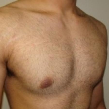 After image 4 Case #79046 - Gynecomastia