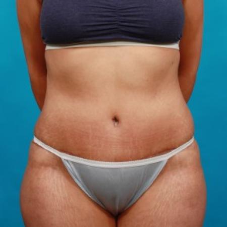 After image 1 Case #85746 - Abdominoplasty with Flank Liposuction