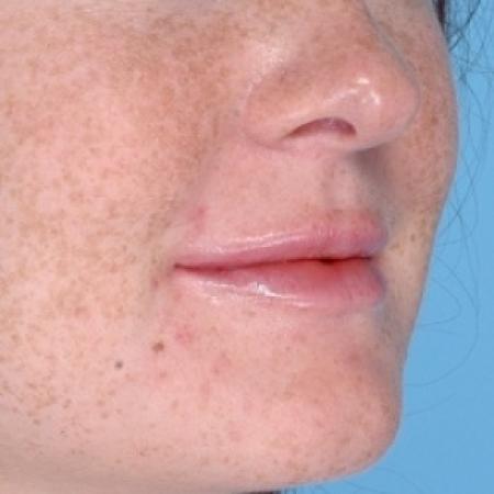 After image 2 Case #79291 - Injectables