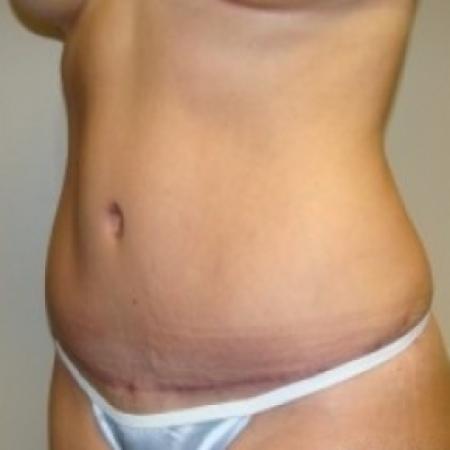After image 2 Case #79491 - Tummy Tuck