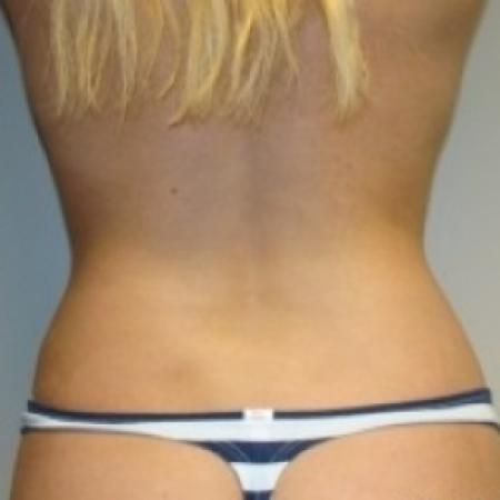 After image 4 Case #79496 - Tummy Tuck