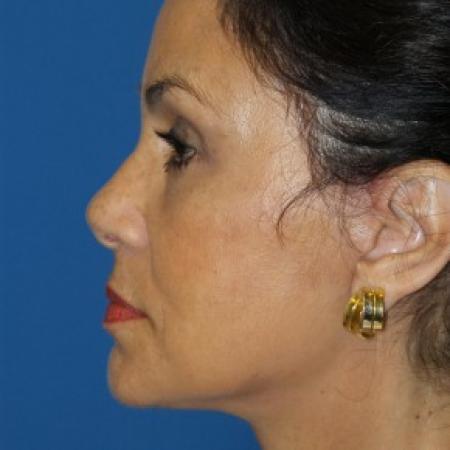 After image 3 Case #86611 - Facelift/Lower Blepharoplasty/Browlift     3 months post-op