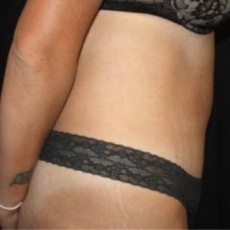 After image 3 Case #84621 - Abdominoplasty - 35 year old female