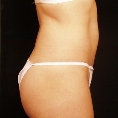 After image 3 Case #81751 - Liposuction