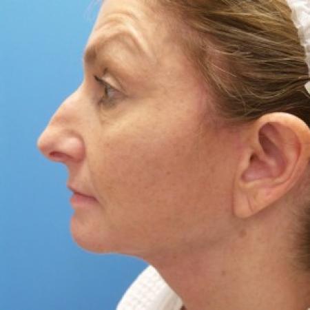 After image 3 Case #87171 - 55 year old  -  Facelift  -   3 month post-op