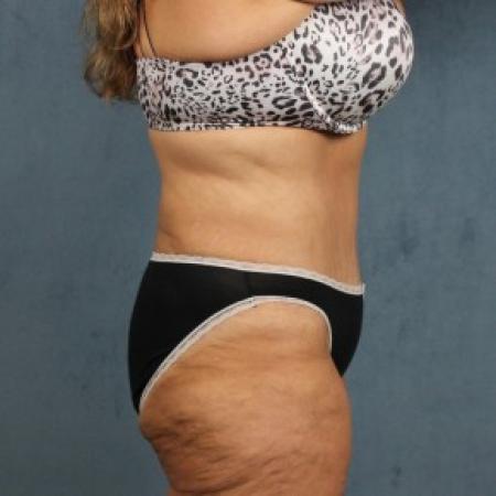 After image 3 Case #82551 - extended abdominoplasty (tummy tuck) after massive weight loss