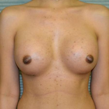 After image 1 Case #87781 - Breast Augmentation with Mentor Memorygel 325cc high profile smooth round gel