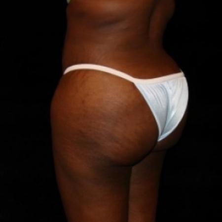 After image 2 Case #80486 - Buttocks Augmentation Via Fat Grafting with Liposuction of Abdomen, Waist, Flanks, and Dorsal Roll