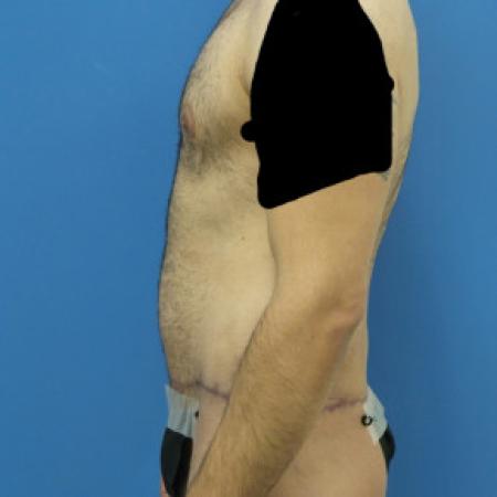 After Case #88451 - Circumferential Body Lift /Gynecomastia Reduction