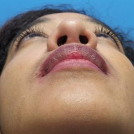 After image 4 Case #86471 - Rhinoplasty/Septoplasty/Turbinectomy - 1 year post-op