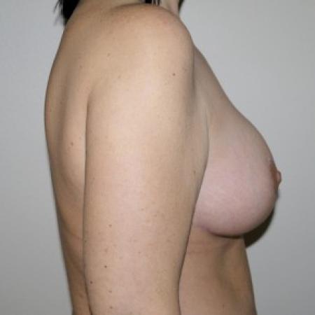 After image 3 Case #82566 - Full Mastopexy