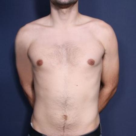 After image 1 Case #84856 - 26 Years Old Male