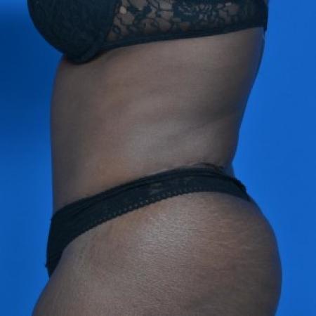 After image 3 Case #87871 - Tummy Tuck