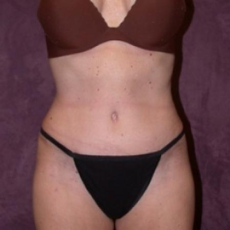 After image 1 Case #79891 - Tummy tuck with liposuction of hips
